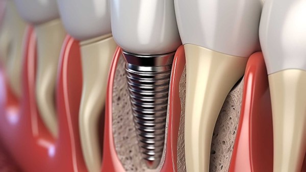 Vente Professional dental implants in geneva