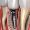 Professional dental implants in geneva pas cher